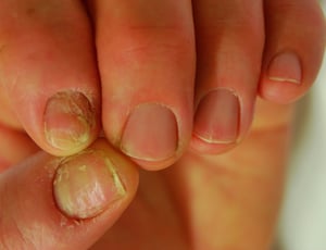 爪甲の腫脹，爪上皮の消失，および爪甲の異常を伴う慢性爪囲炎