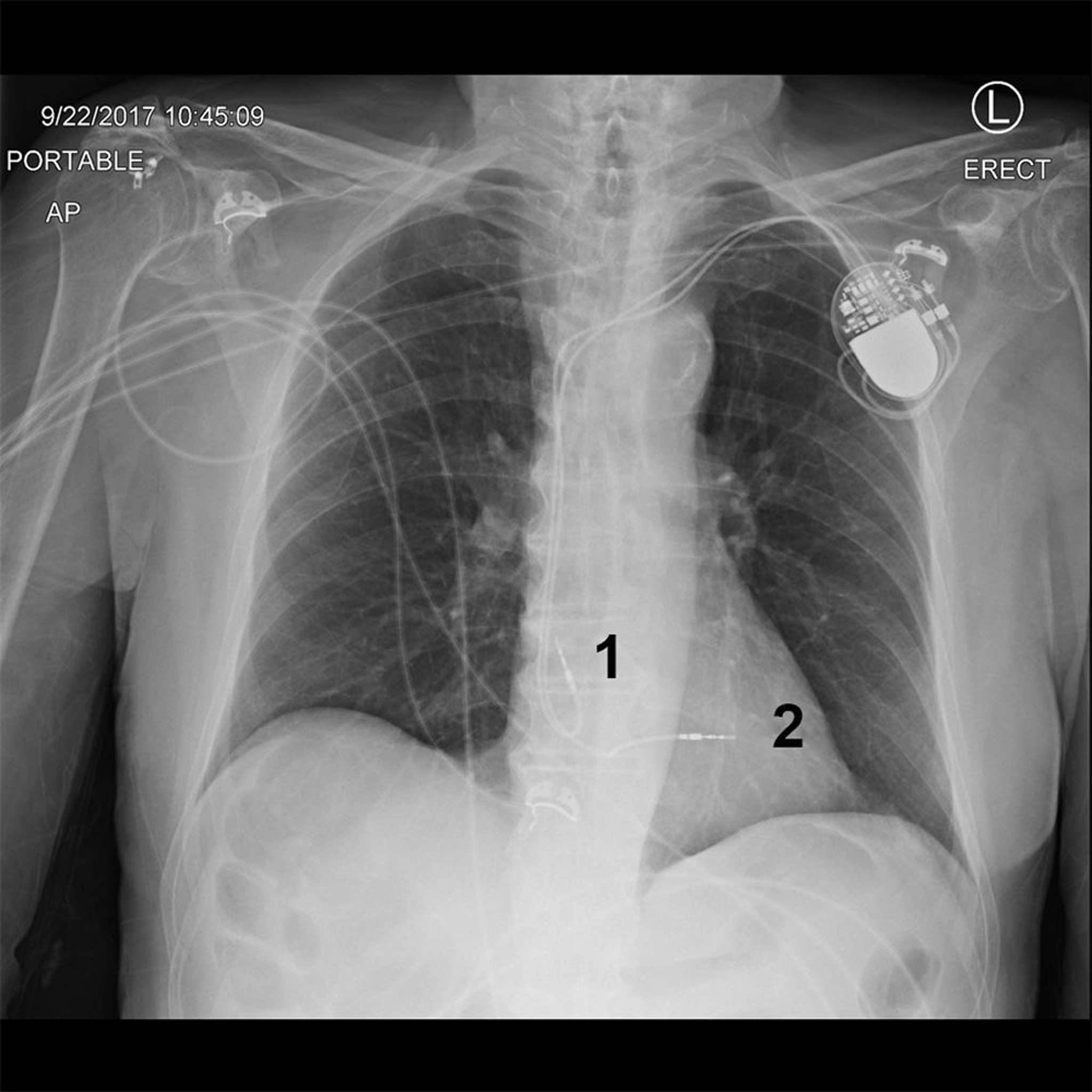 Radiographie thoracique d'un patient porteur d'un stimulateur cardiaque