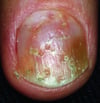 Psoriasis ungueal con fositas y cambio de coloración