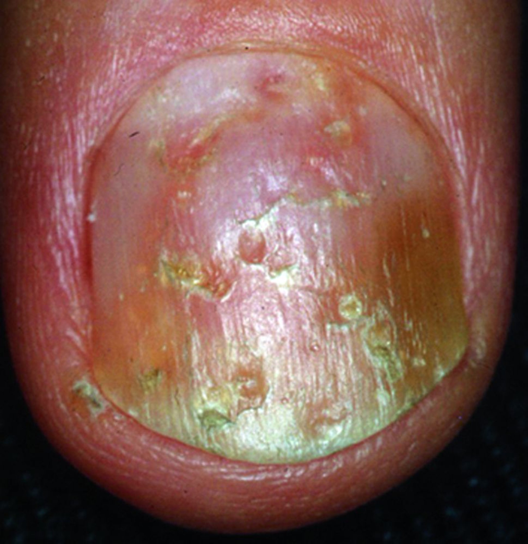 Psoriasi delle unghie con superficie irregolare e anomalia di colorazione