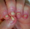 Psoriasis del lecho ungueal con onicólisis