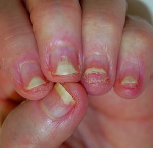 Psoriasis del lecho ungueal con onicólisis