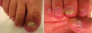 Nagel-Psoriasis mit Verdickung und Zerbröckeln der Nagelplatte