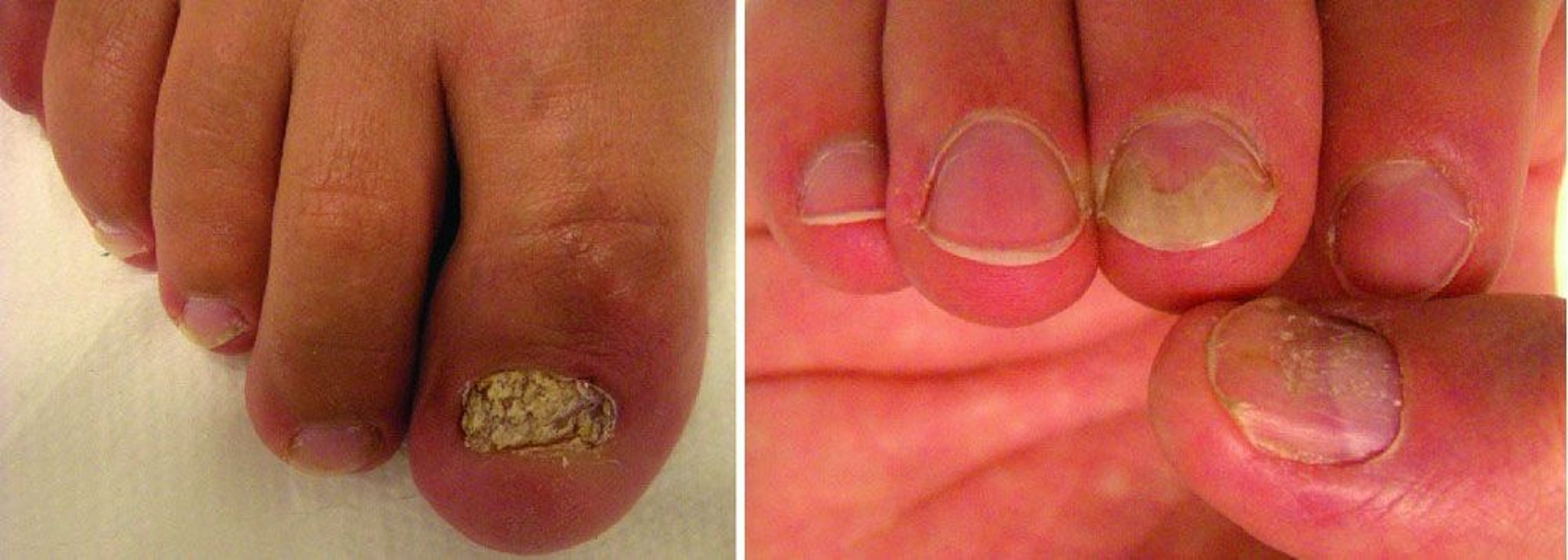 Nail Psoriasis With Thickening and Crumbling of the Nail Plate