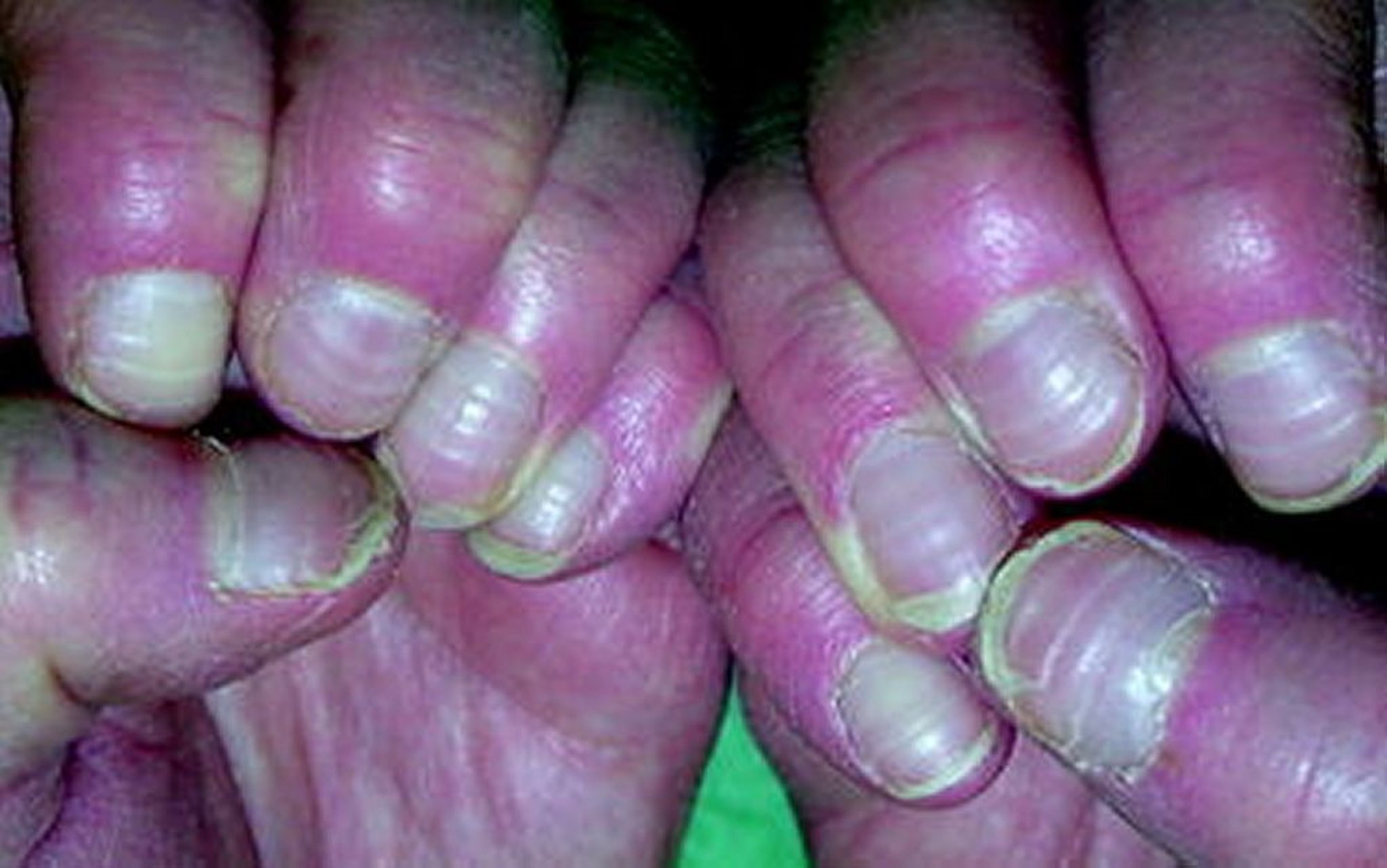 Líneas de Beau debido a la quimioterapia