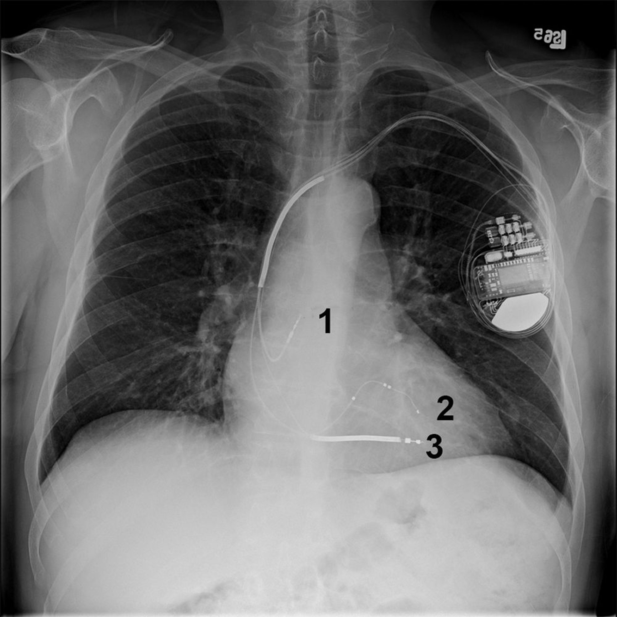 Radiografia del torace di un paziente con cardiovertitore-defibrillatore impiantabile biventricolare (bi-V)