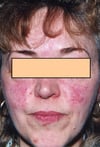 Telangiectasia en la cara