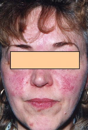 Telangiectasia en la cara