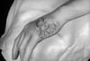 Tertiary Syphilis (Gumma)