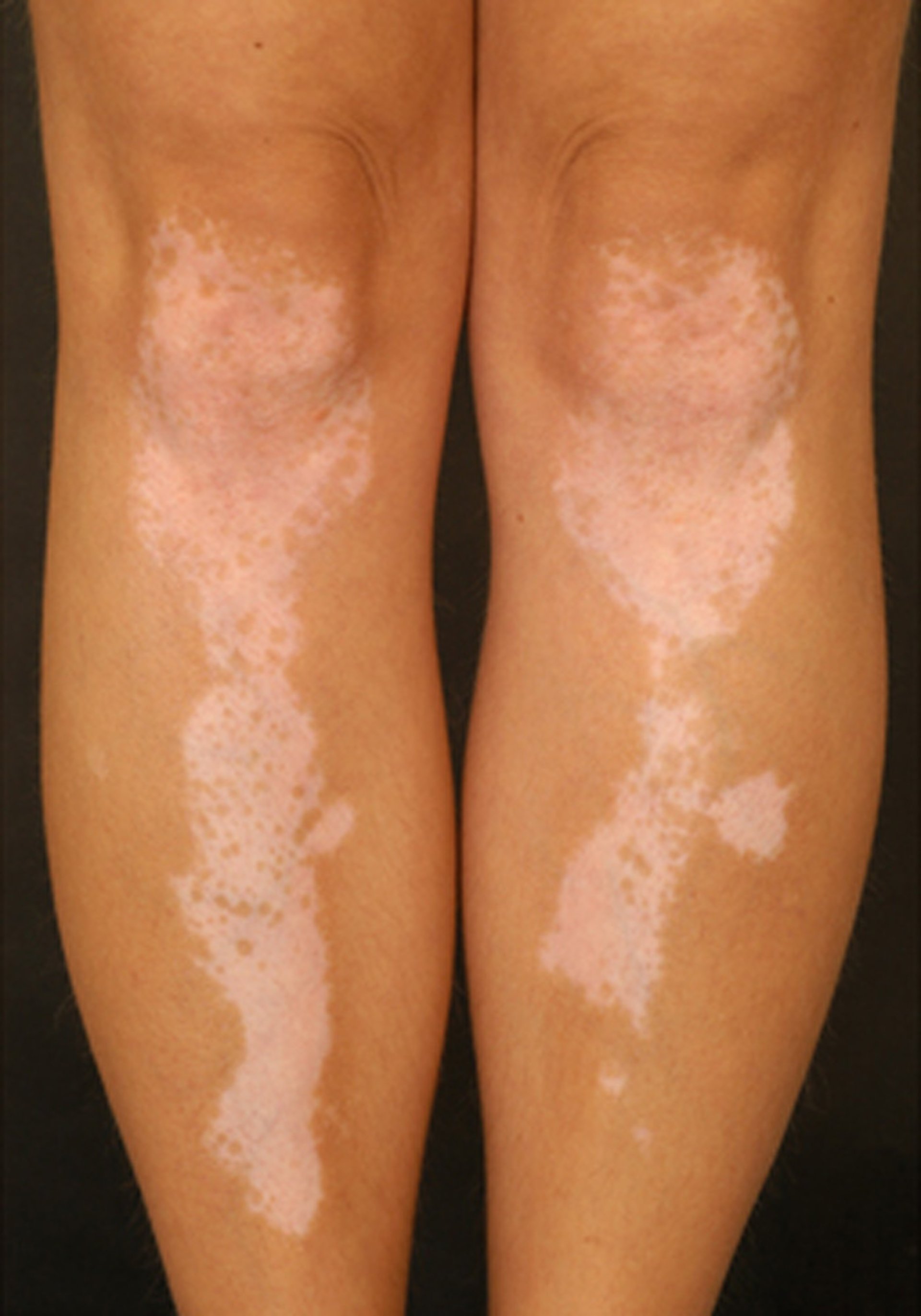 Symmetric Vitiligo on the Legs