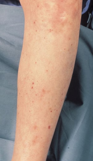 Petequias secundarias a meningococcemia (Pierna)