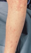 Chấm xuất huyết thứ phát sau nhiễm khuẩn huyết do Meningococcus (chân)