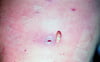 Wound Myiasis