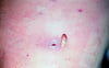 Wound Myiasis