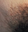 Pediculosis Pubis (Pubic Lice) With Nits Attached to Pubic Hair