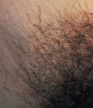 Pediculosis Pubis (Pubic Lice) With Nits Attached to Pubic Hair