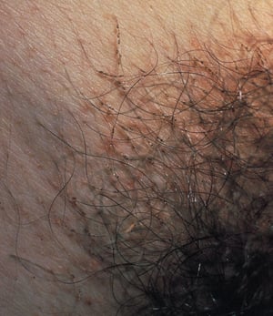 Pediculosis del pubis (piojos púbicos) con liendres adheridas al vello púbico