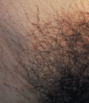 Pédiculose pubienne (poux du pubis) avec lentes attachées aux poils pubiens