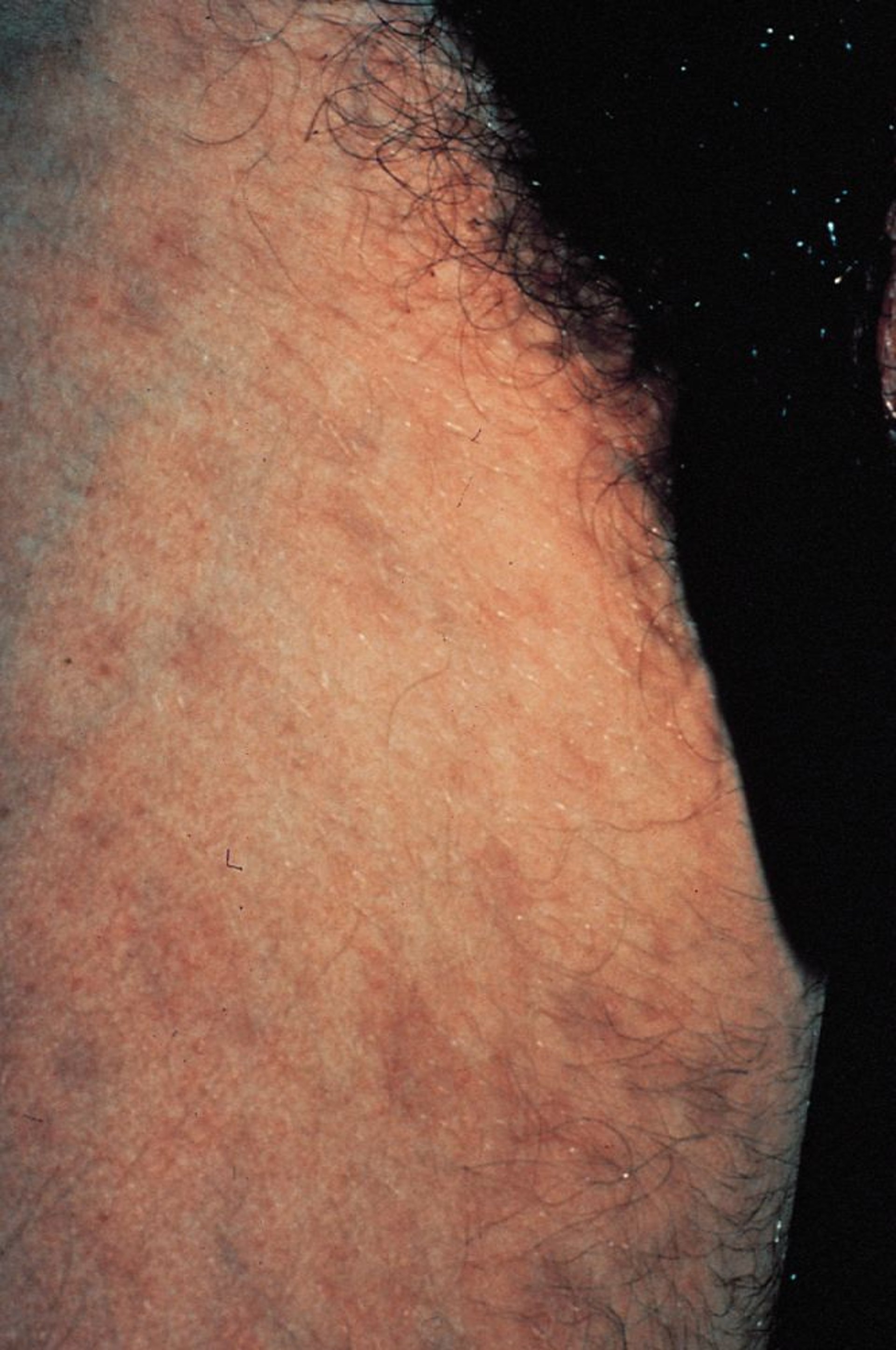 Pediculosis Pubis (Pubic Lice) With Maculae Ceruleae