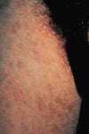 Pediculosis pubis (Filzläuse) mit Maculae ceruleae
