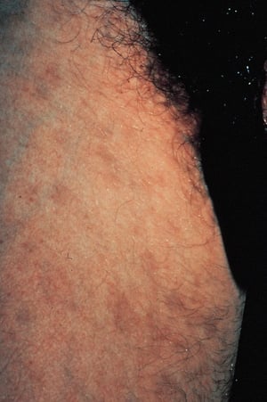 Pediculosis púbica (piojos púbicos) con máculas cerúleas
