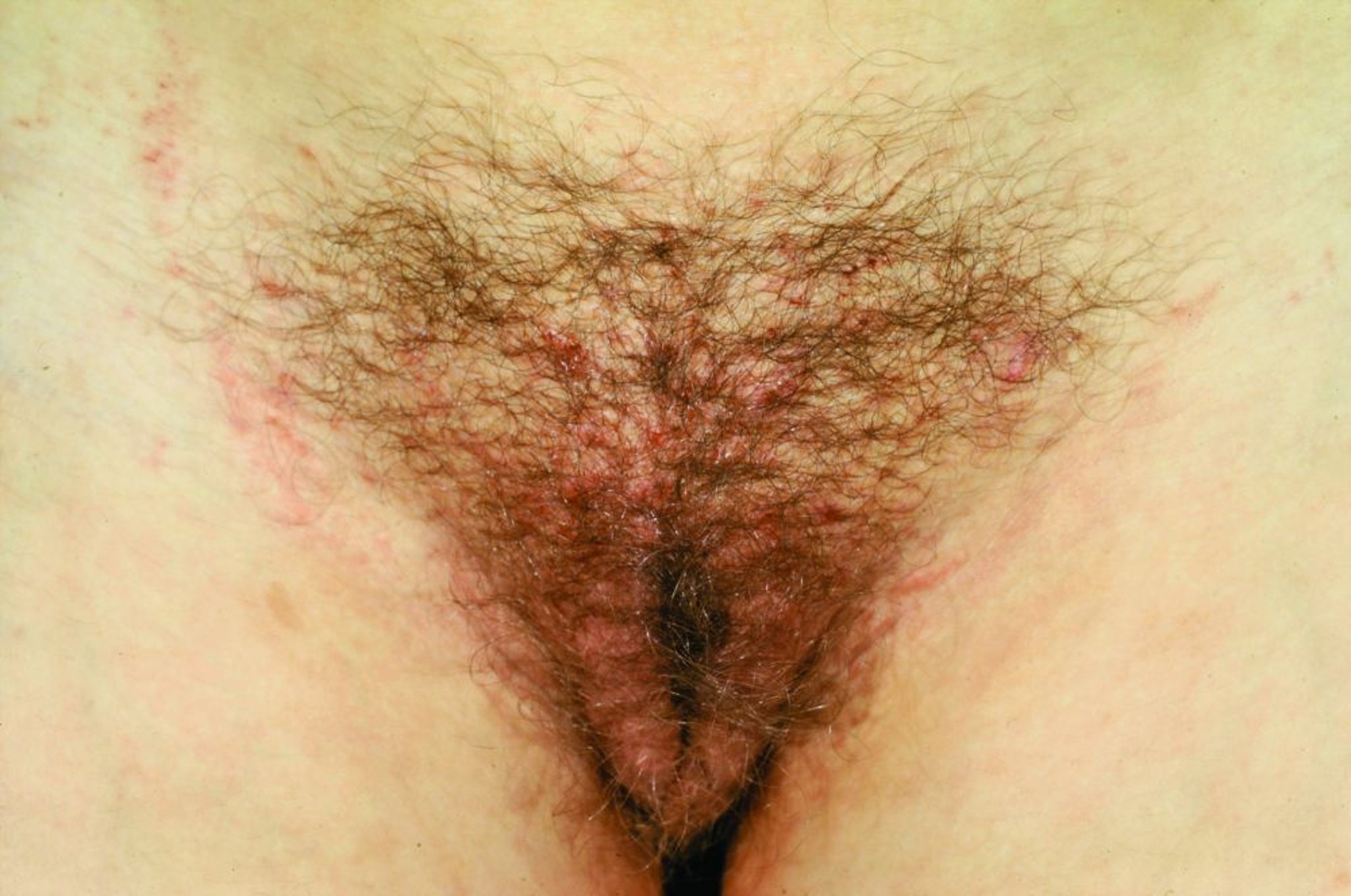 Pediculosis pubis (Filzläuse) mit Exkoriationen