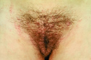 Pediculosis Pubis (rận mu) có trầy da