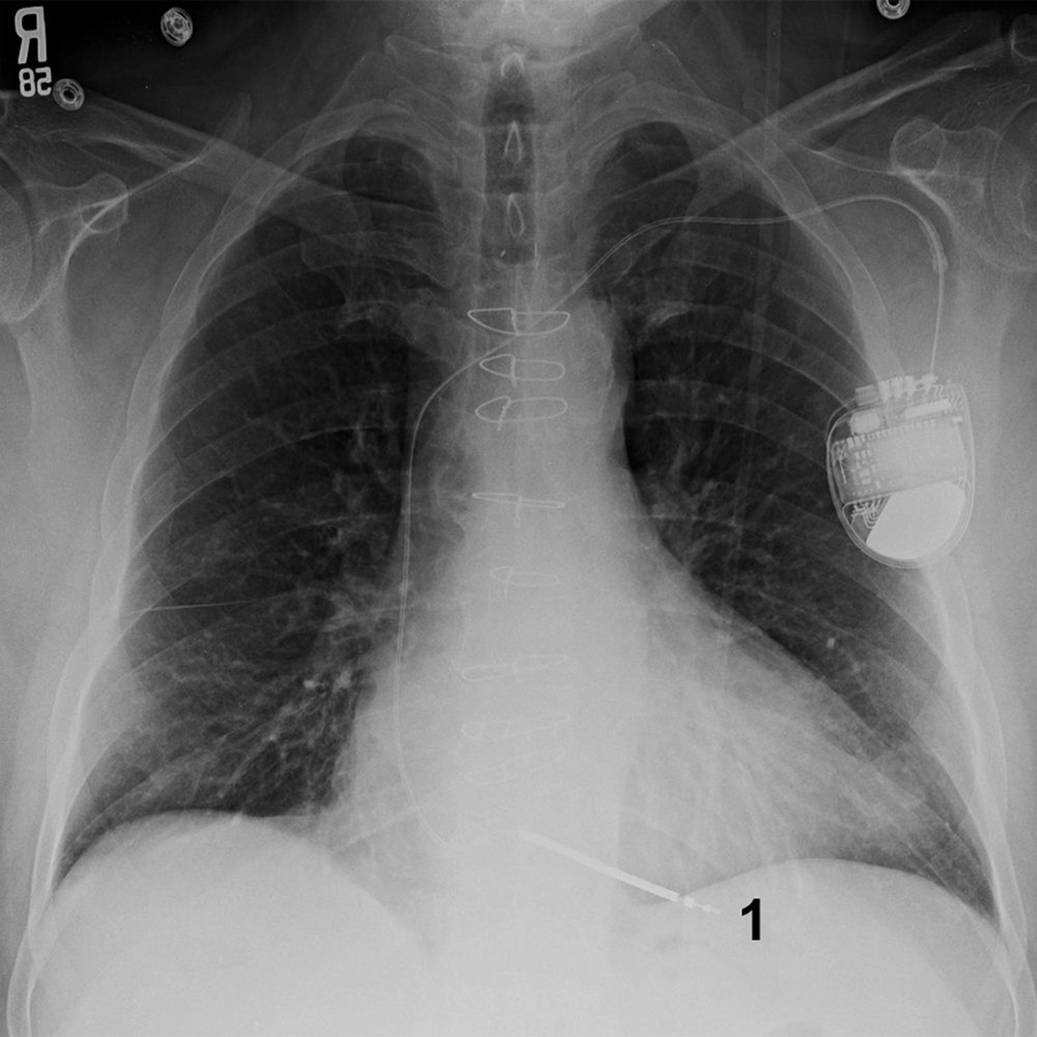 Röntgenthorax eines Patienten mit einem implantierbaren Kardioverter-Defibrillator