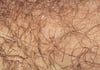 Pediculosis pubis (Filzläuse) mit Läusekot
