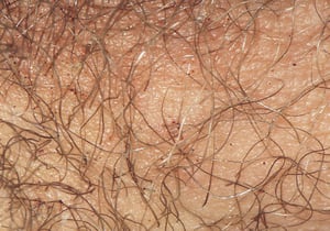 Pediculosis pubis (Filzläuse) mit Läusekot