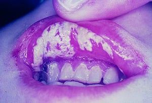 Candidíase oral (mucosa labial)