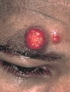 Bacilläre Angiomatose (bei einem Patienten mit HIV-Infektion)