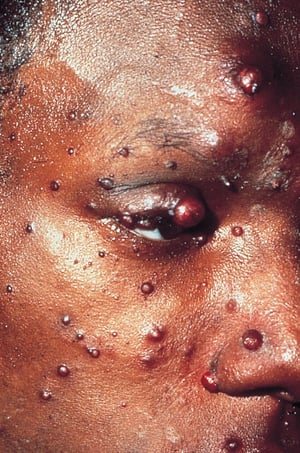 Bartonellose disséminée dans l'infection par le VIH