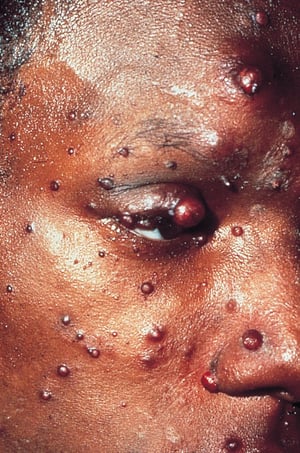 HIV感染中的播散性巴尔通体病