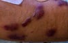 Kaposi Sarcoma