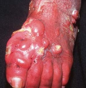 Micetoma (nodular)