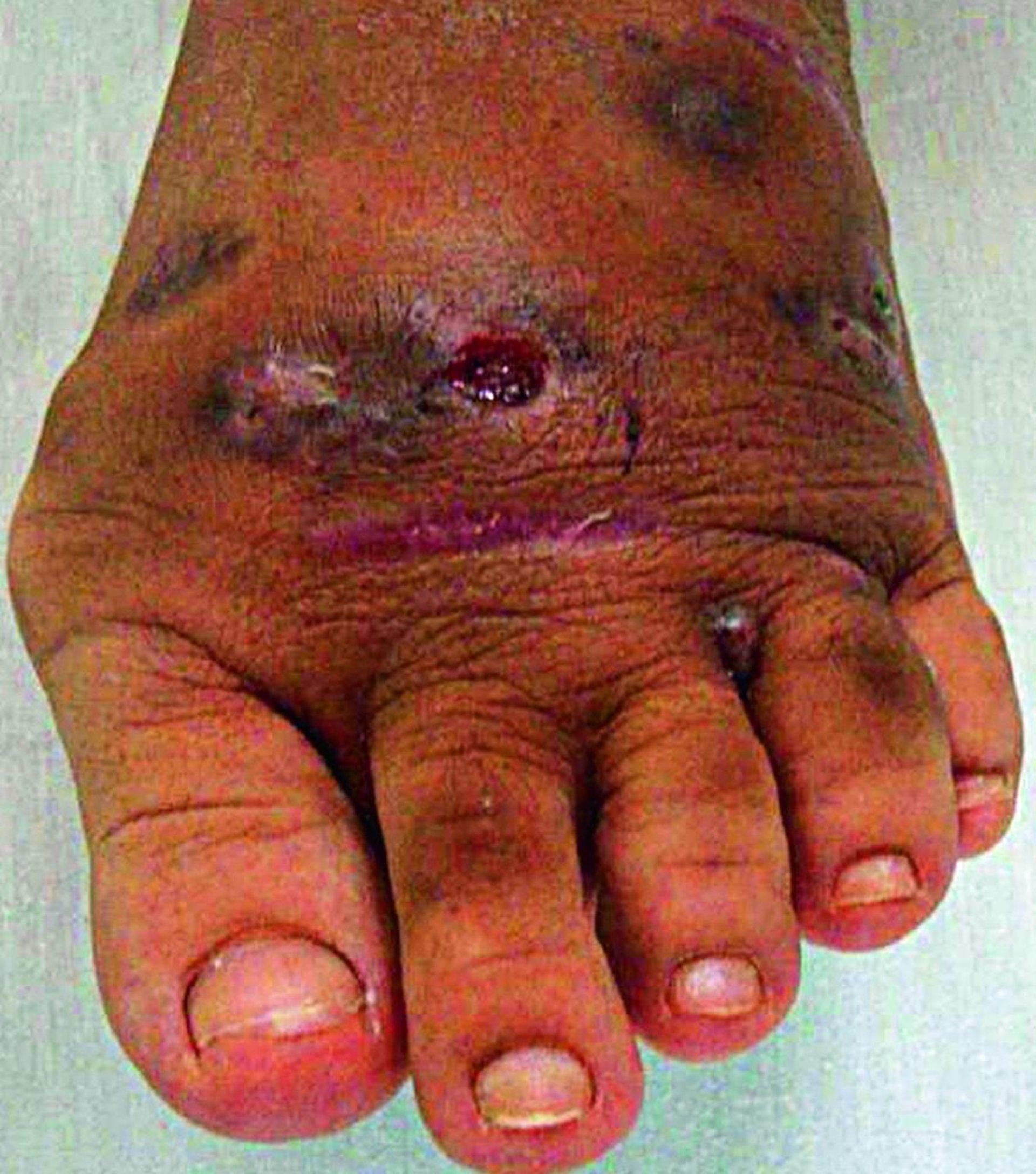 Mycetoma (Skin Rupture)