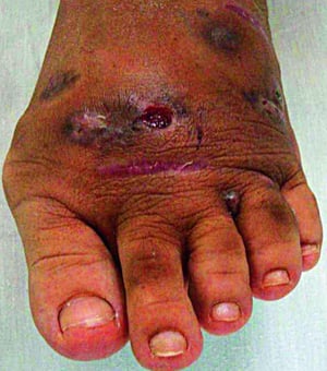 Micetoma (rotura de la piel)