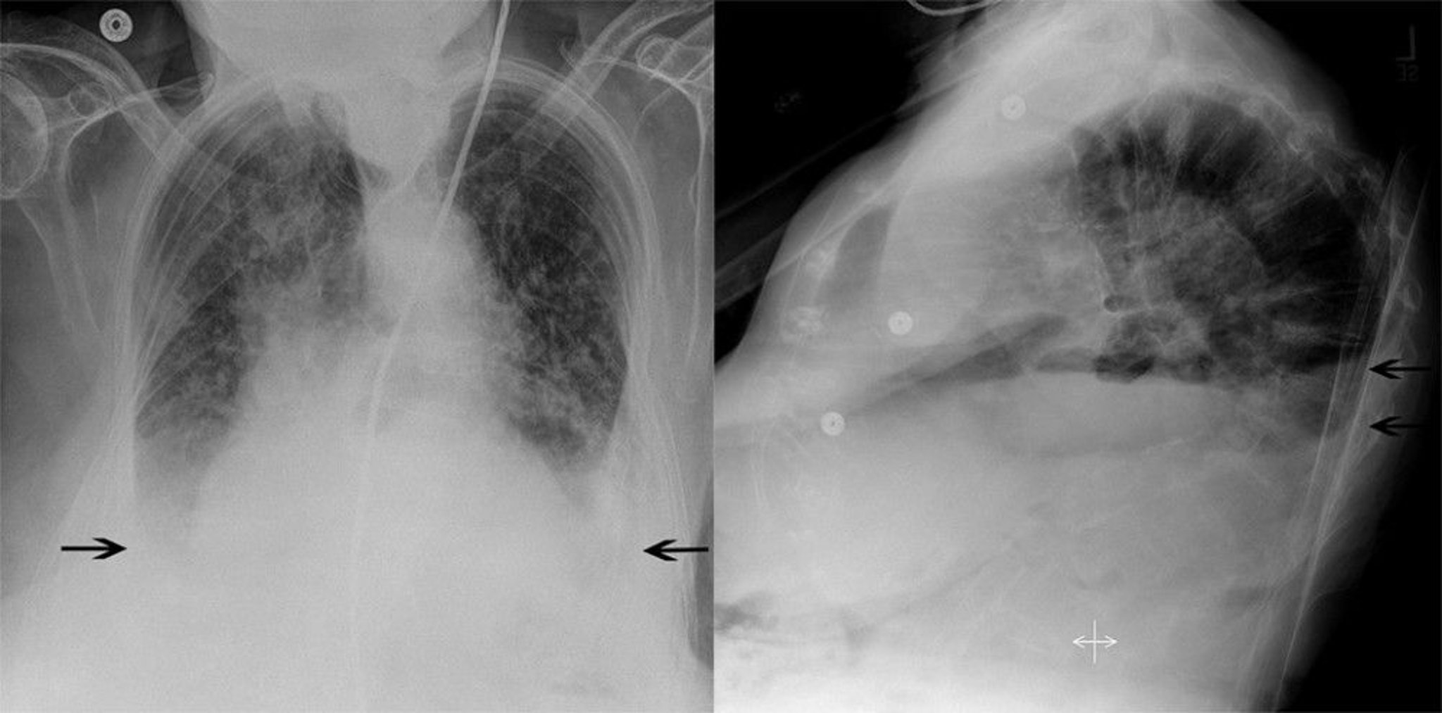 Chest Radiograph of a Patient with Pulmonary Edema and Bilateral Pleural Effusions