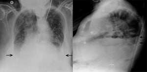 Röntgenthorax eines Patienten mit bilateralen Pleuraergüssen