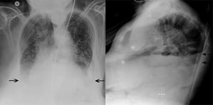 両側性胸水のある患者の胸部X線