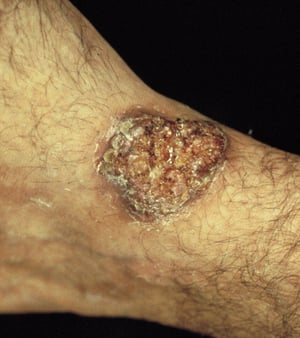 Extrapulmonale Blastomykose (Ulzerativ mit Mikroabszessen)