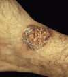 Blastomicose extrapulmonar (ulcerativa com microabcessos)