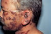 Kaposi Sarcoma (Face)