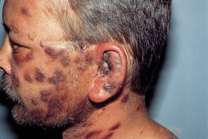 Sarcoma de Kaposi (face)