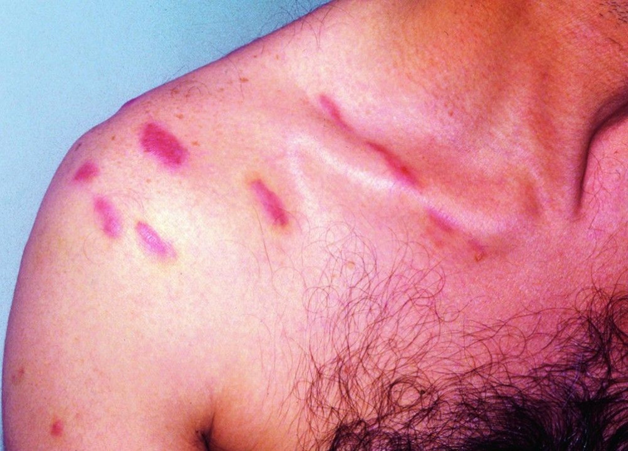 Kaposi Sarcoma (Shoulder)