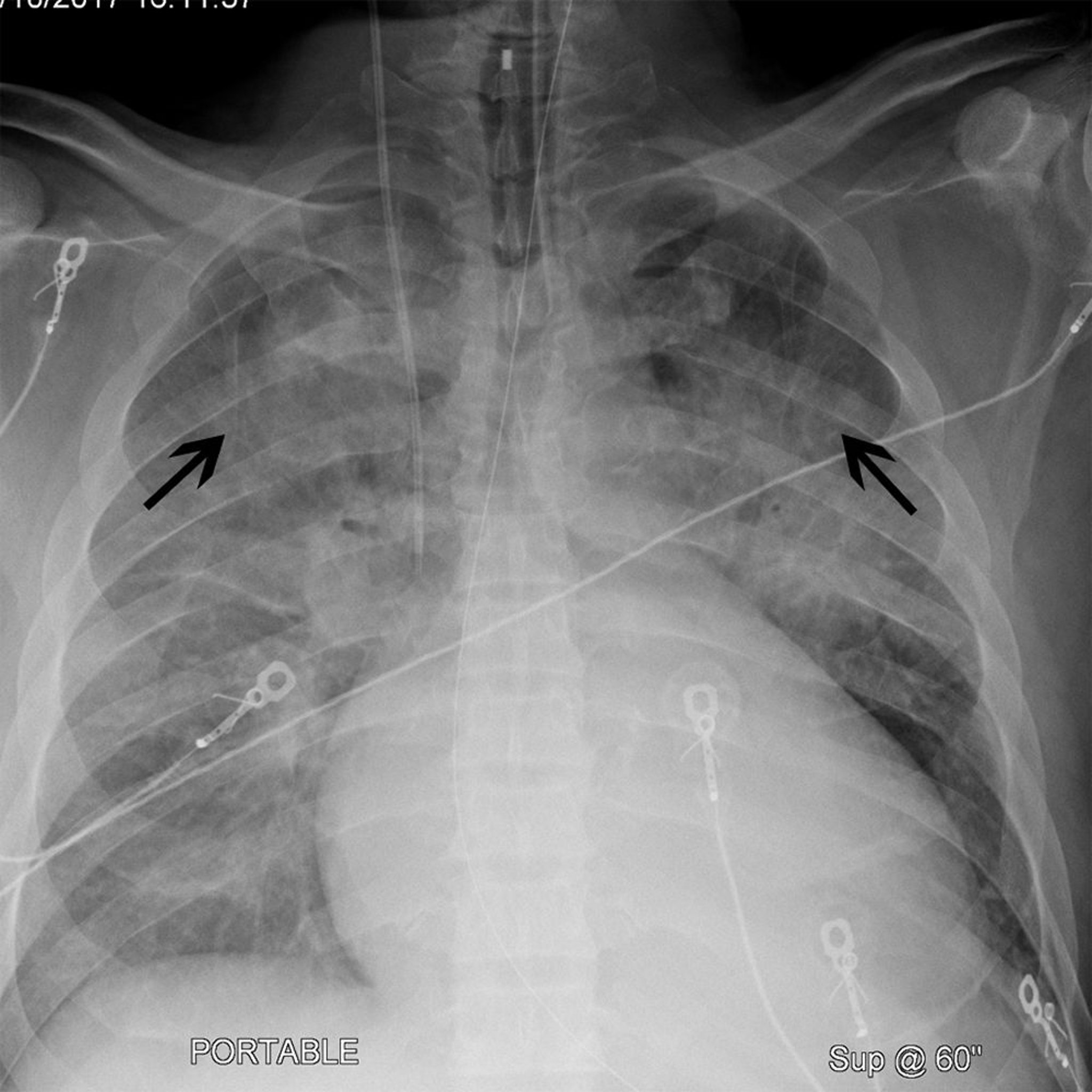 Radiografía de tórax de un paciente con cardiomegalia y cefalización