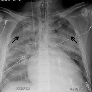 Phim chụp X-quang ngực của một bệnh nhân có hình ảnh tim to và hình ảnh tĩnh mạch phía trên phổi lớn hơn hoặc bằng tĩnh mạch phía dưới