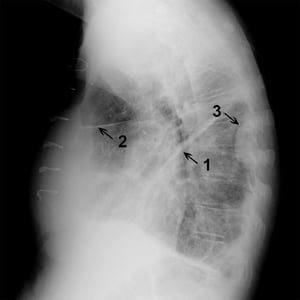 Röntgenthorax eines Patienten mit Flüssigkeit in kleinen und großen Fissuren