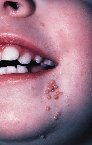 小児の顔面に発生した伝染性軟属腫